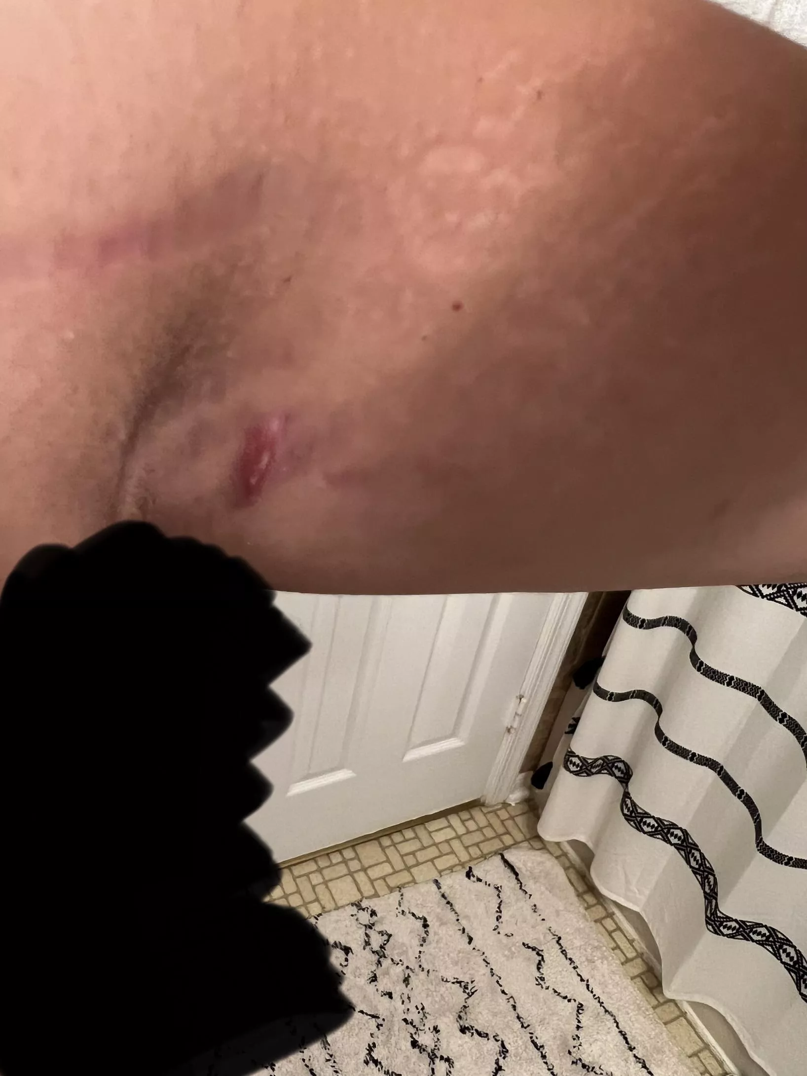 Does anyone know what this is on my stretch mark under my armpit? It was super inflamed last month and now it’s been like this for a couple weeks. (Black covering my arm pit hair)