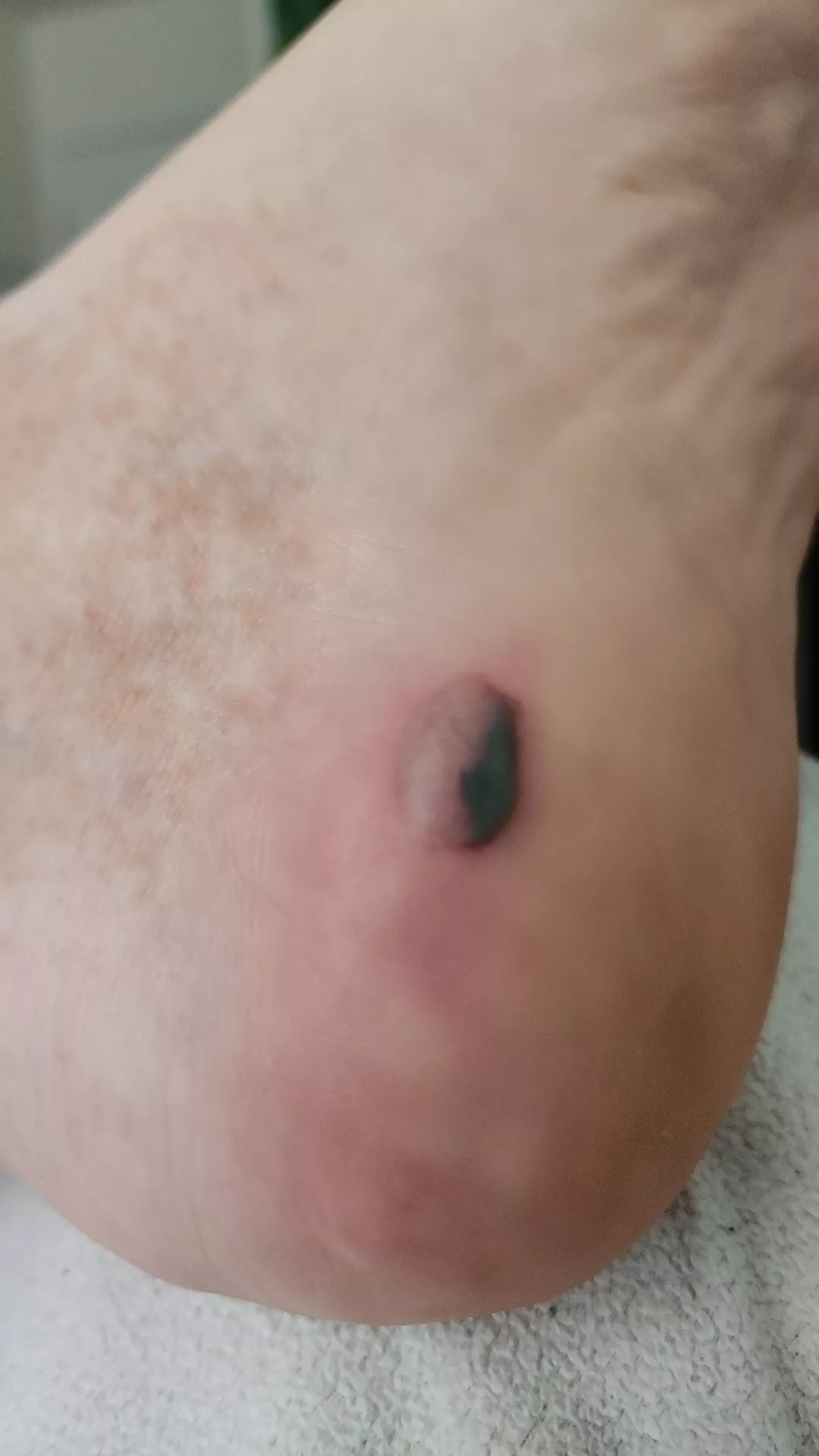 I've never had a foot blister this bad, how do I treat it? I have work in 3 days :(