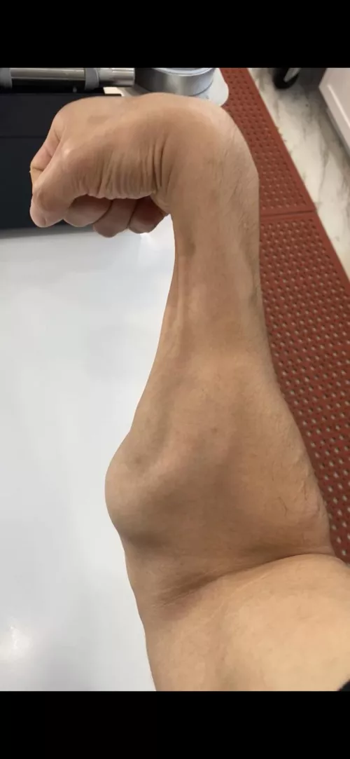 Uneven forearm ! Is this normal ? I hardly train my forearm somehow it’s been keep getting bigger
