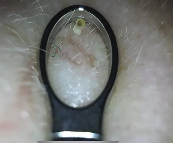 A tiny mushroom (blackhead pop on the cheek)