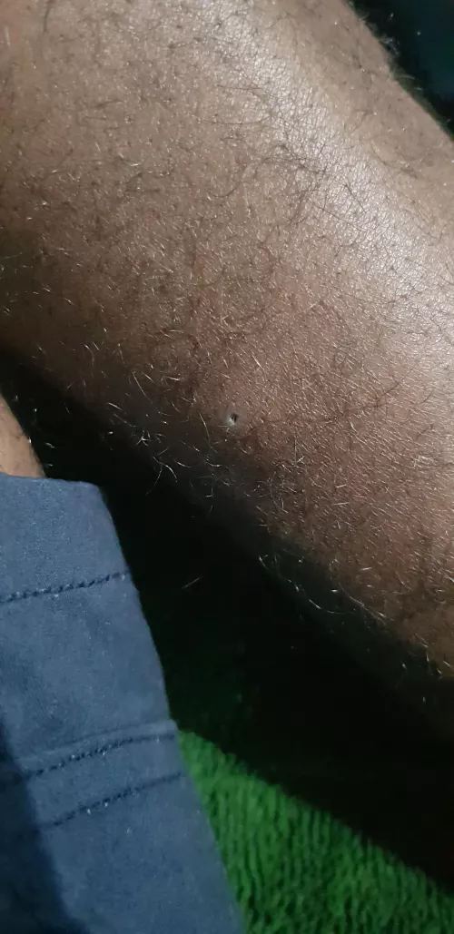 just discovered this on my calf, looked like a scab till i started squizing/picking, whats it? a hole?
