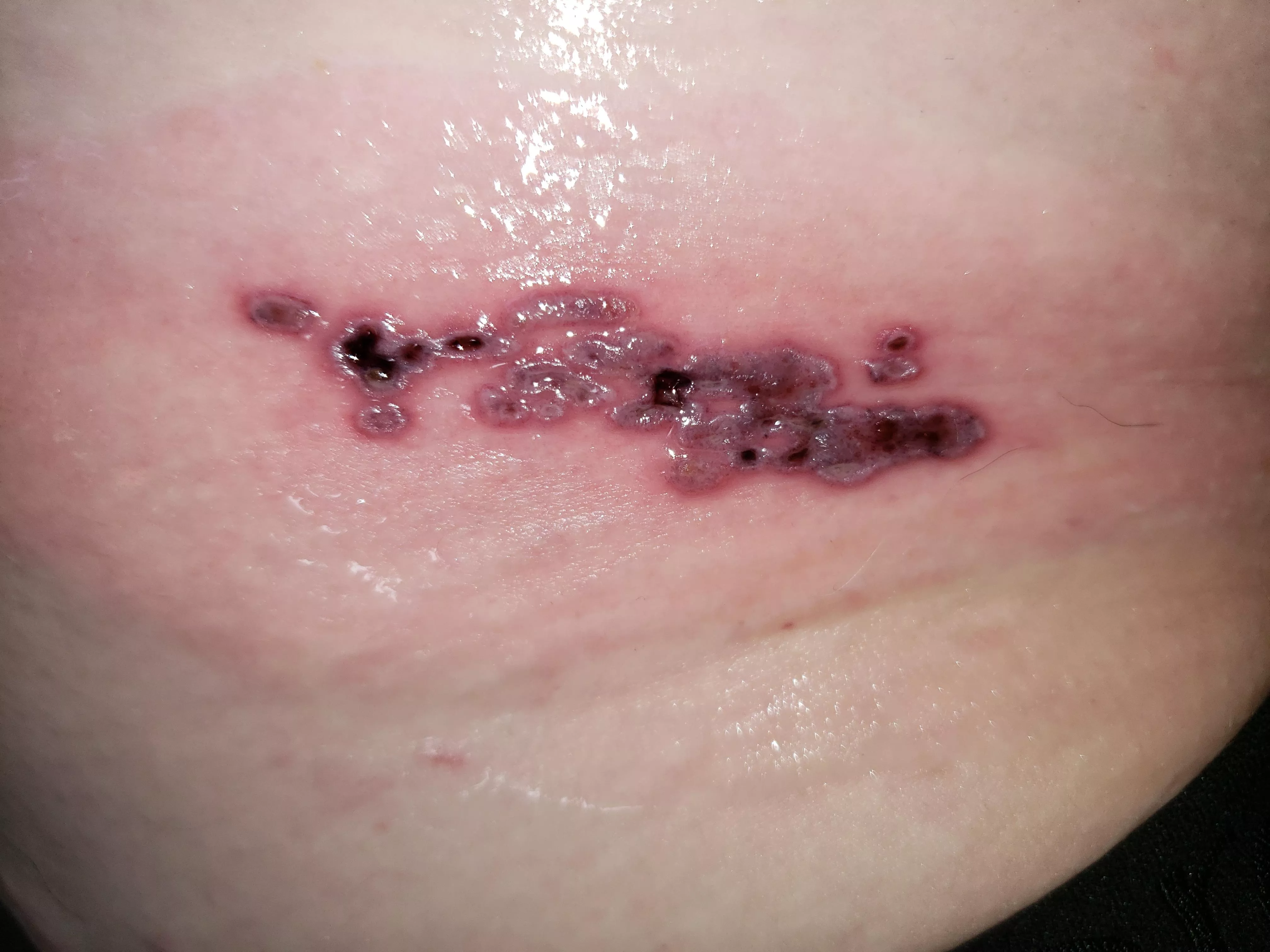 My worst cluster of shingles. Forbidden pops, excruciating pain.