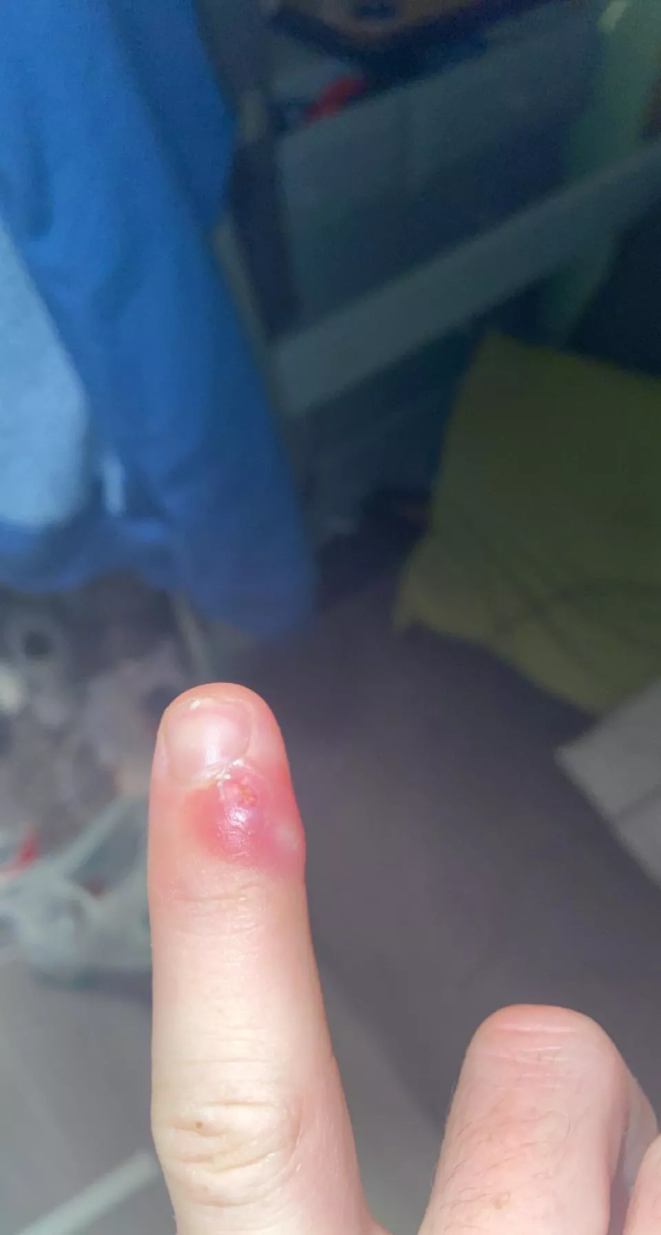 Some hangnail amirite