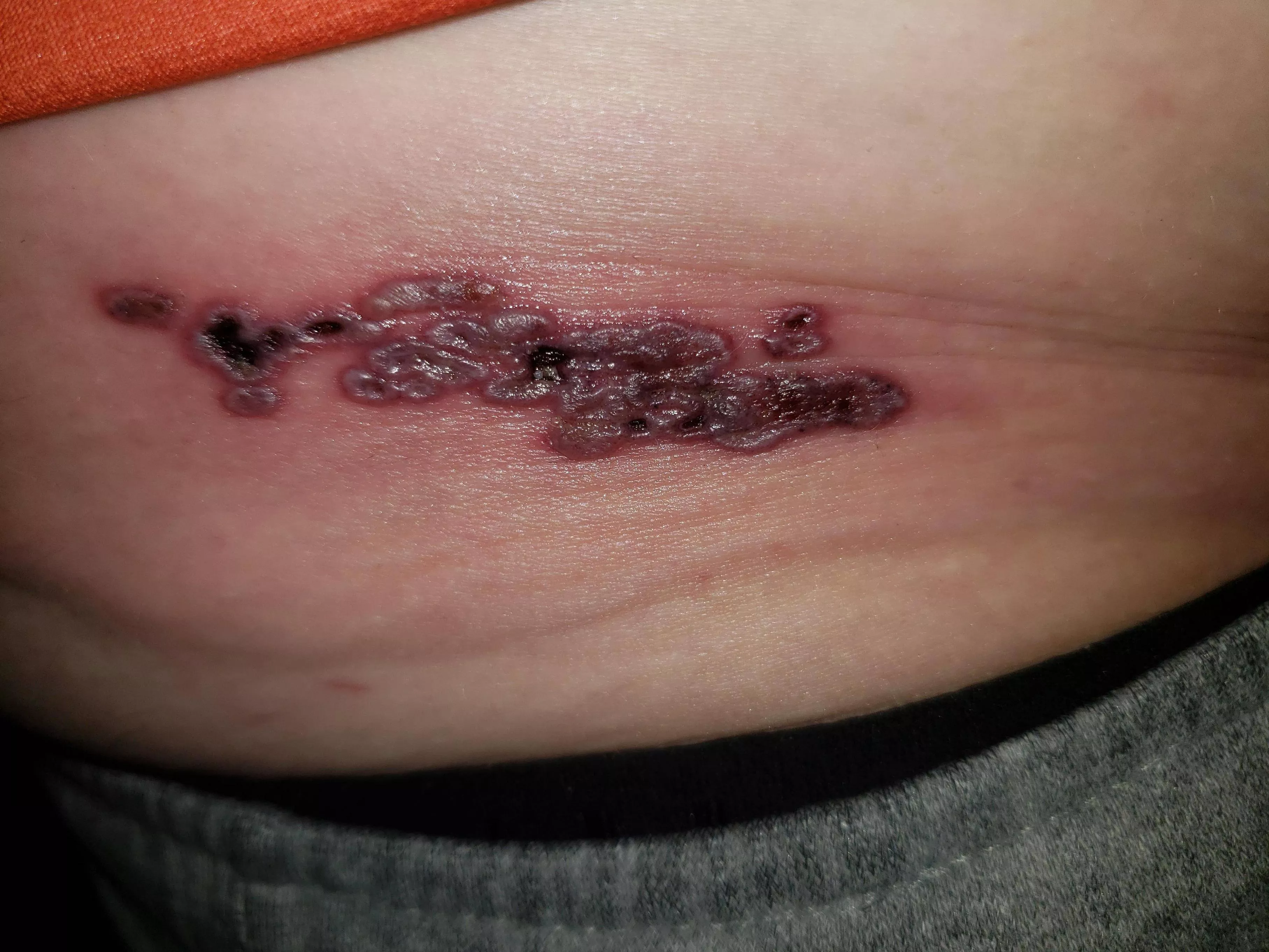 Update on my forbidden pops cluster: really &@#%$^& hurts