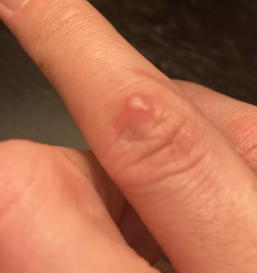 Weird little white spot on knuckle?