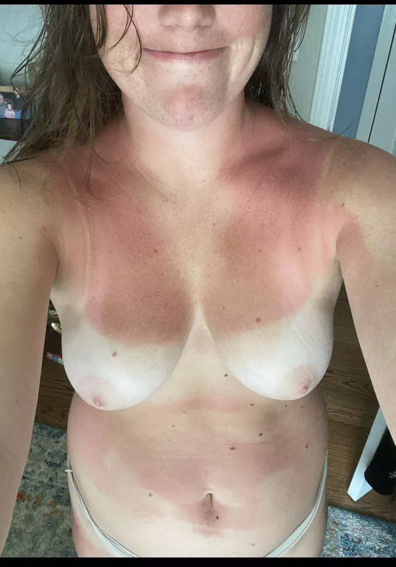 My chubby gf after getting sunburnt at lake. What do you think of her body?