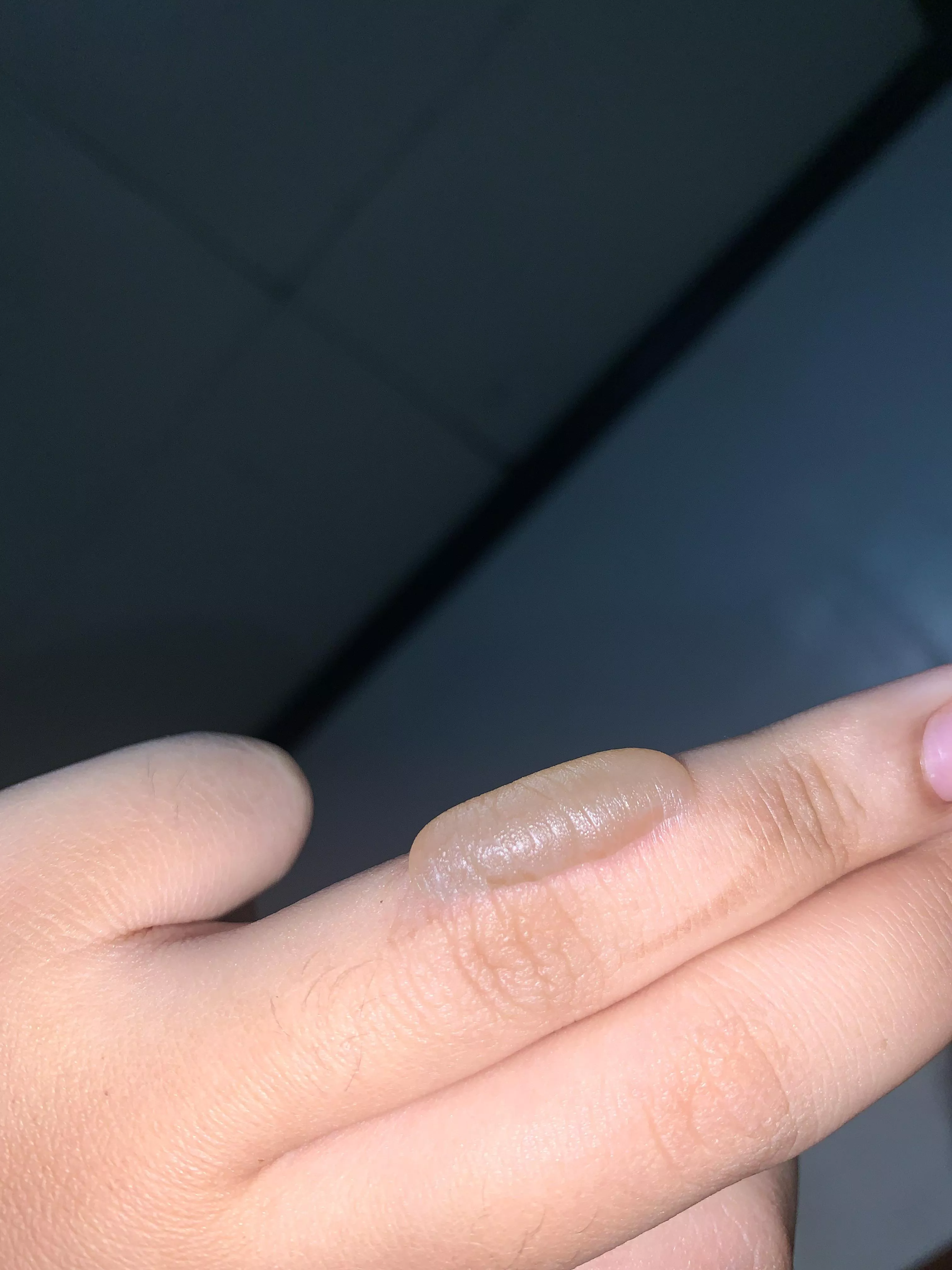 Treating this 4-day old burn blister as my little baby 😝