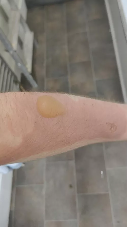 got a pretty bad burn the other day because I spilled a hot water bottle it was tiny yesterday and I woke up with this