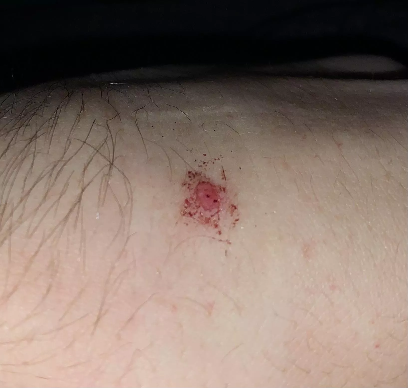 Chopped off my own skin tag