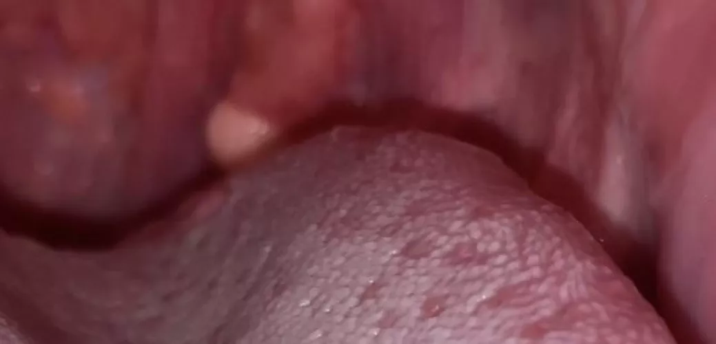 Help…something shaped like ball in throat (pic included)