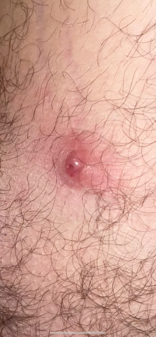 This uncomfortable large bump appeared in the nether region. What is it. Tried to squeeze it but nothing came out (that mighta been a mistake) I sprayed with anti-bacterial spray and covered with band-aid for now.
