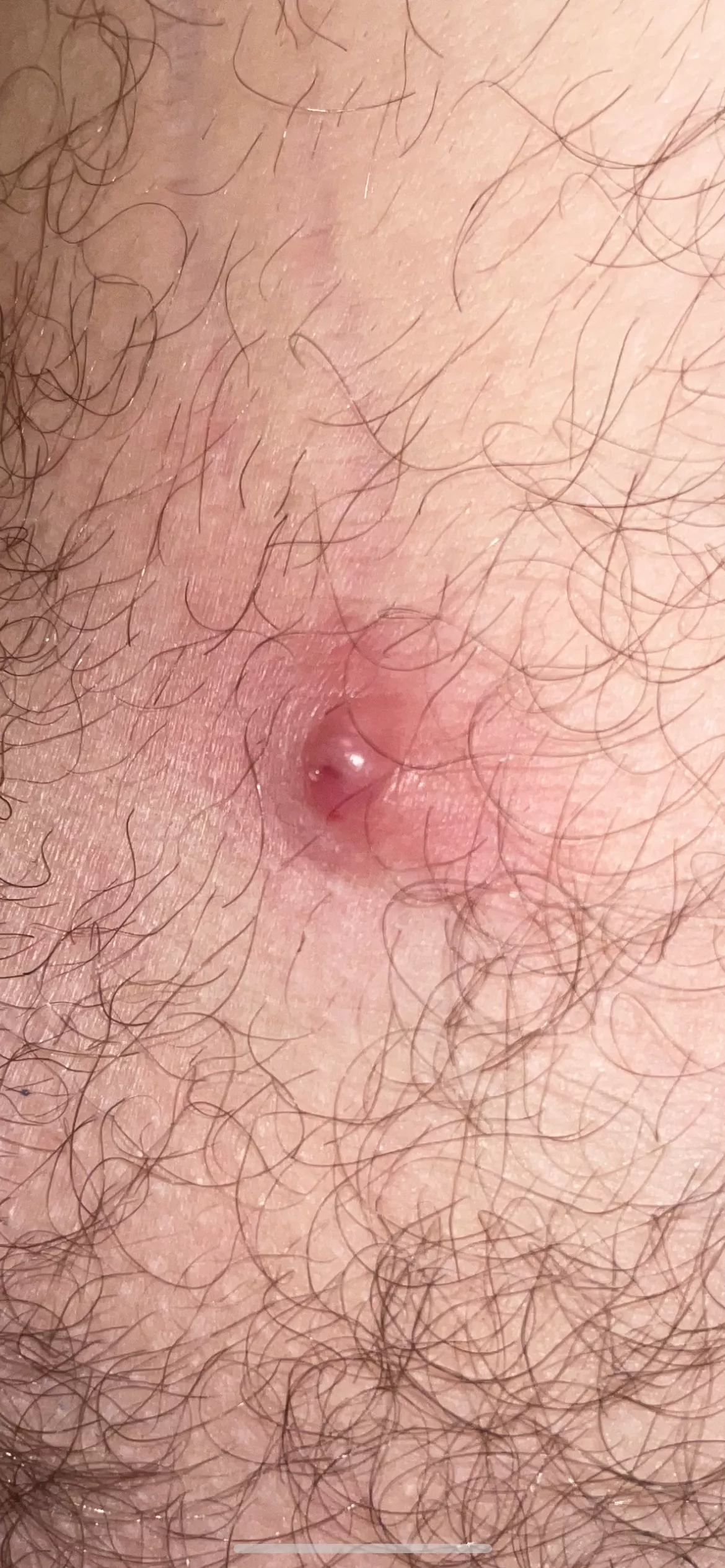 This uncomfortable large bump appeared in the nether region. What is it. Tried to squeeze it but nothing came out (that mighta been a mistake) I sprayed with anti-bacterial spray and covered with band-aid for now.
