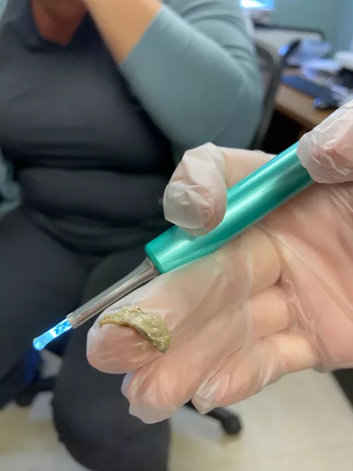 After 2.5 weeks of a blocked ear, using ear wax removal drops and a flushing, a nurse I work with was able to get this sucker out!🤢 (we forgot to hit record sadly) :(