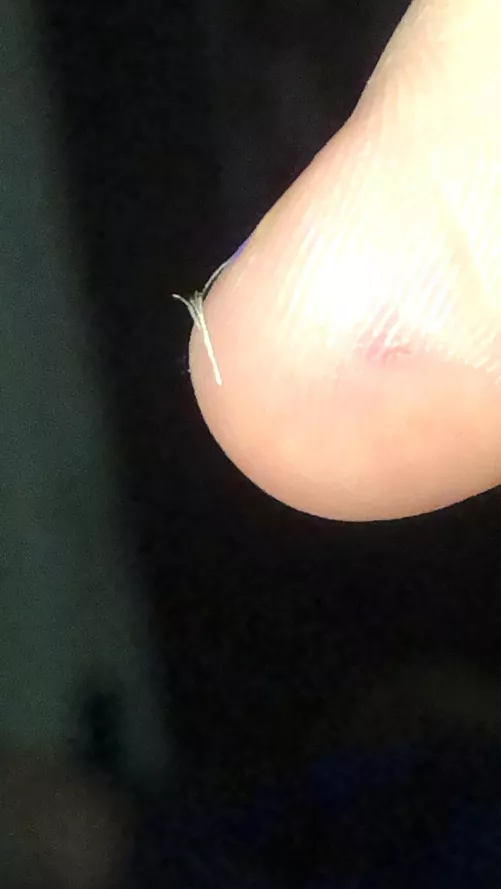 A nice pili multigemini I pulled out of a stretch mark on my side. These are so fun to pull out!