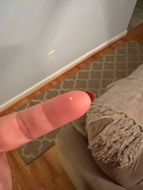 Popped this milia pearl out of forehead today finally