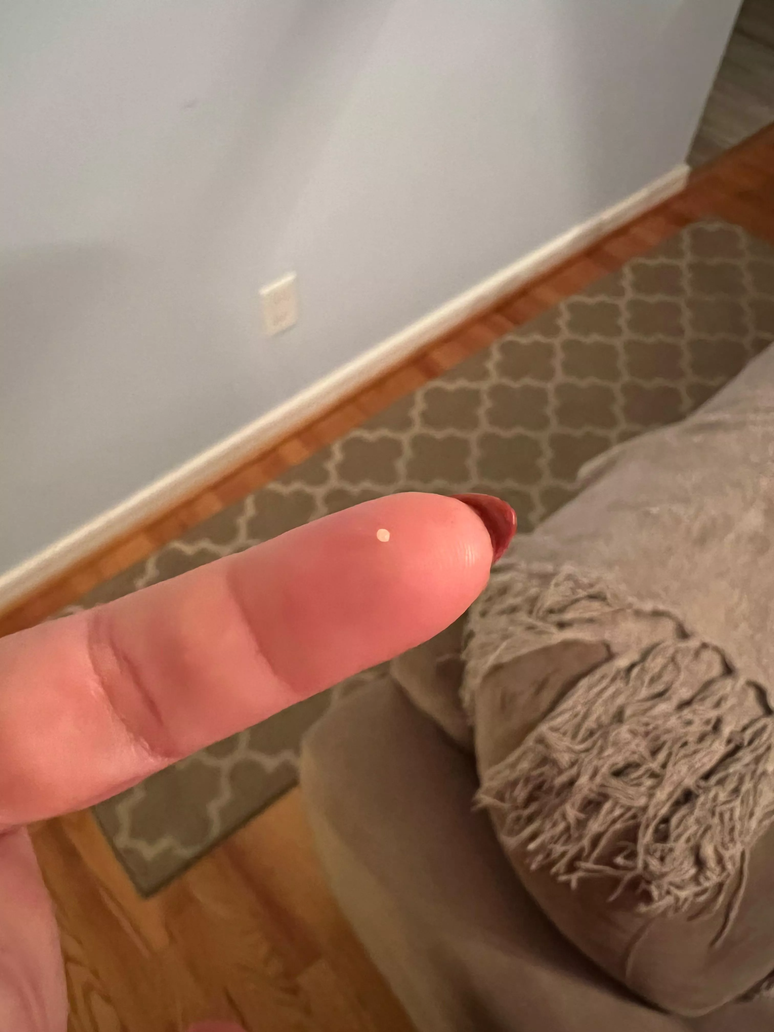 Popped this milia pearl out of forehead today finally