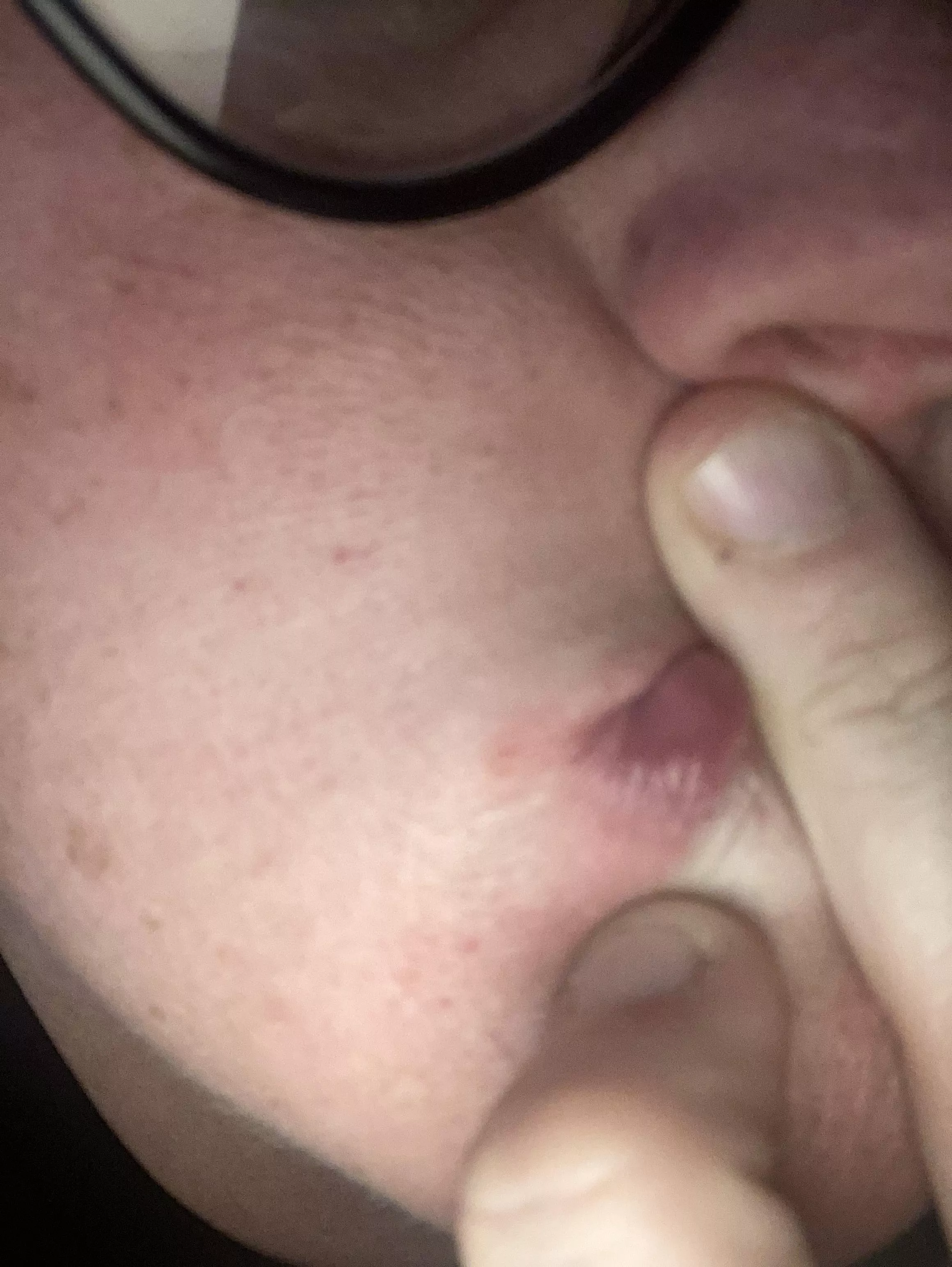 Sorry the pic kinda sucks…This painful little bastard has been festering on my lip the past few days. Just waiting for it to pop!!