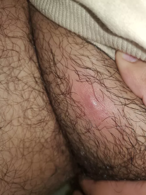 Woke up with this on my upper pubic area, near my thigh. Not sure what it is. Any help is much appreciated!