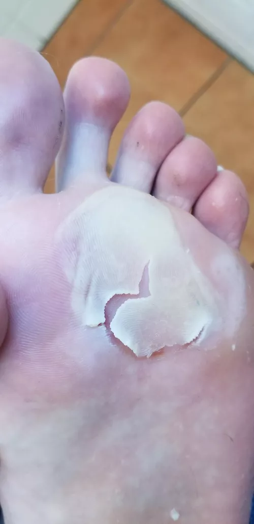 4 days into europe and got this lovely blister that popped itself. Now just worried about infection