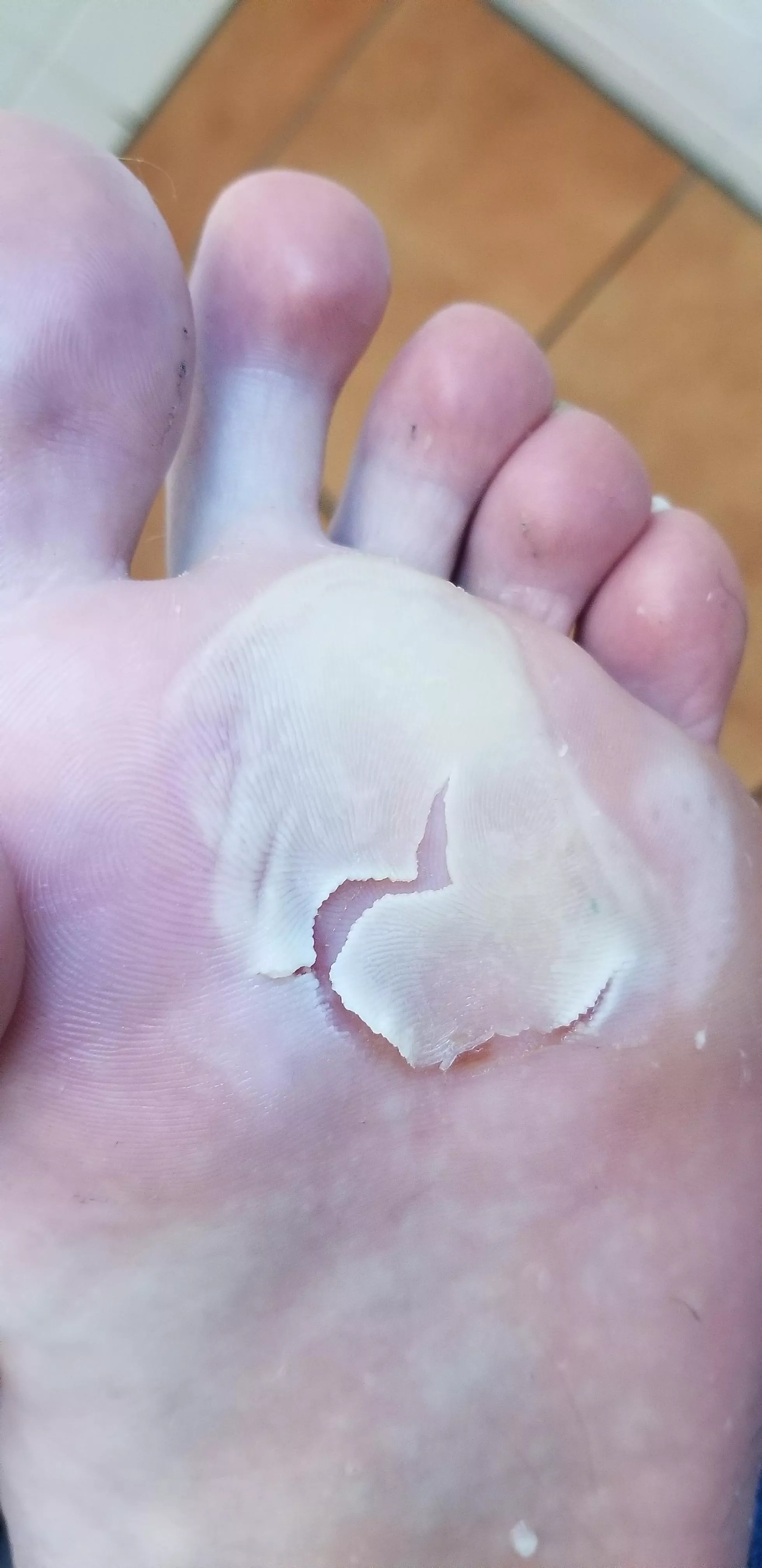4 days into europe and got this lovely blister that popped itself. Now just worried about infection