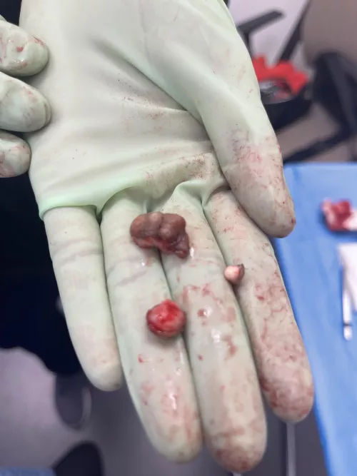 Cyst removed from my balls today.