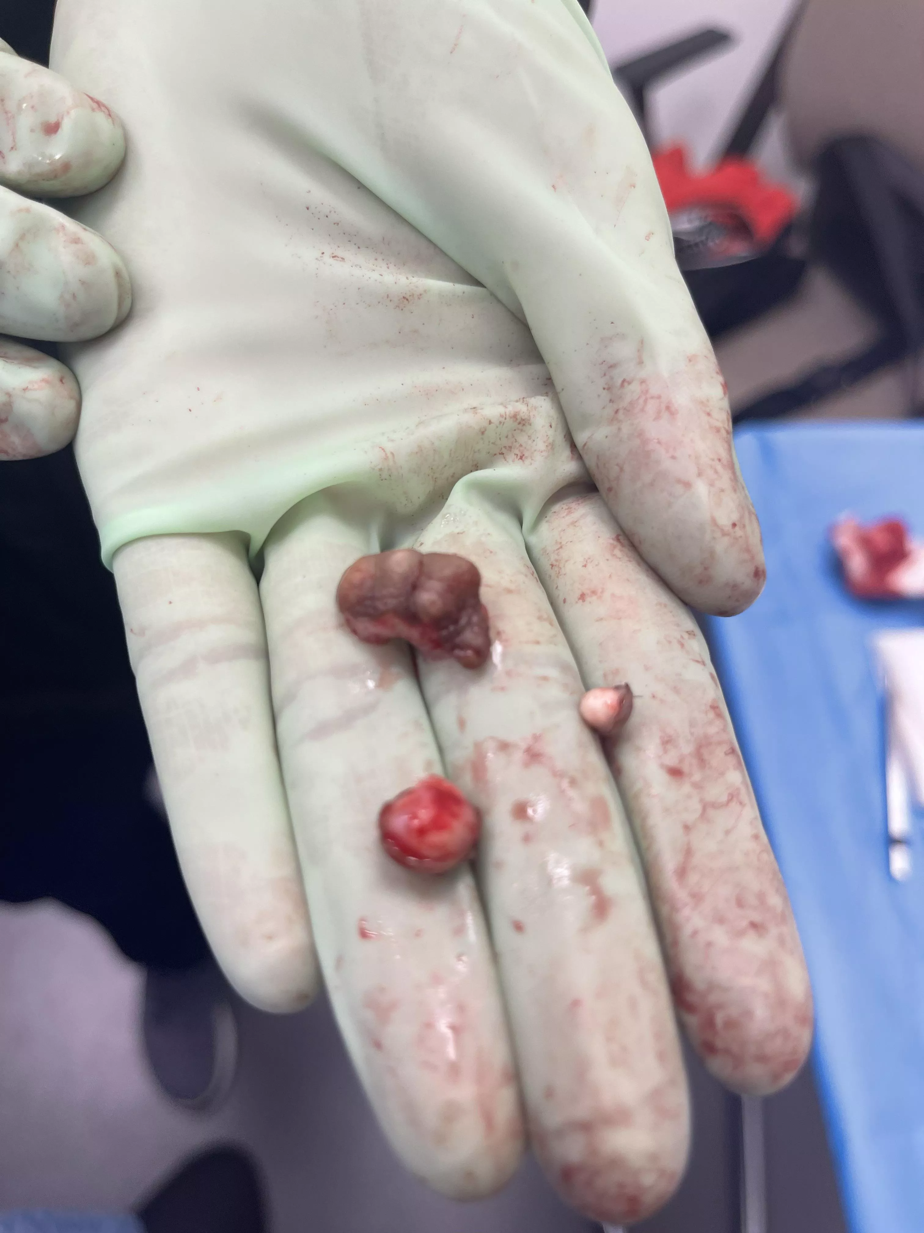 Cyst removed from my balls today.