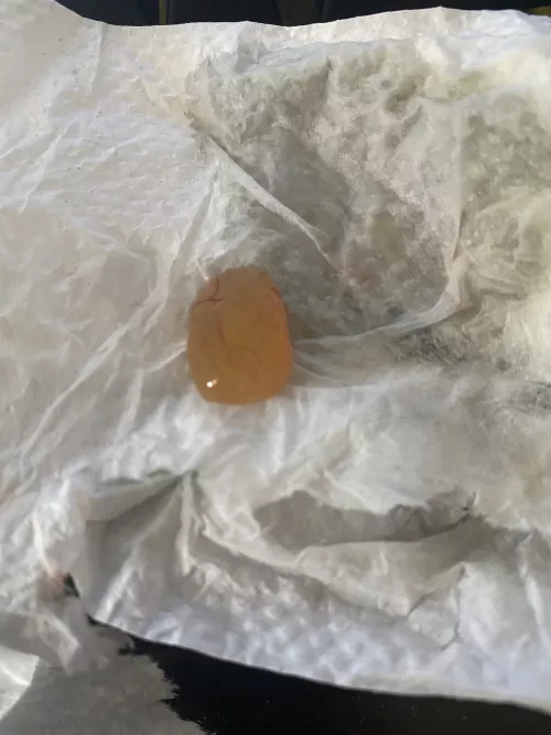 Had nasal polyp surgery for “the most extreme case I’ve ever seen (my surgeon). He put my on dupixent injection every two weeks. A couple weeks ago I felt something loose and blew my nose and this grape popped out