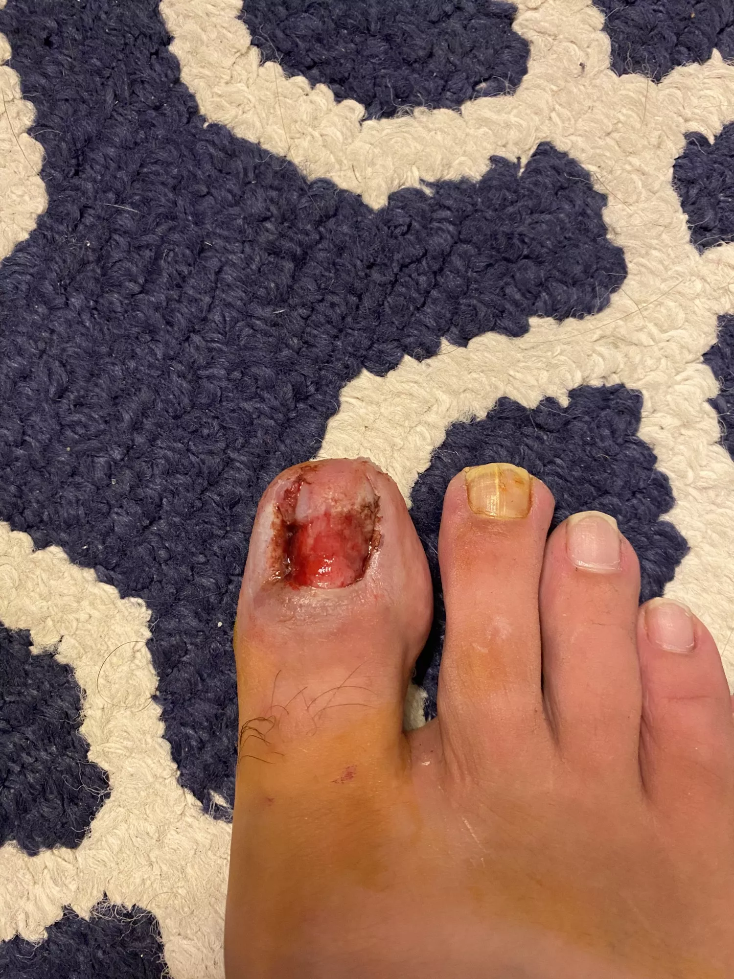 Ingrown on both sides. Whole nail had to come out