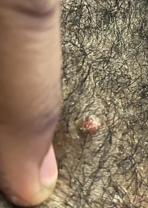 Not sure if this is an ingrown hair or not ? Going to the derm in a week and I want to make sure this isn’t something urgent.
