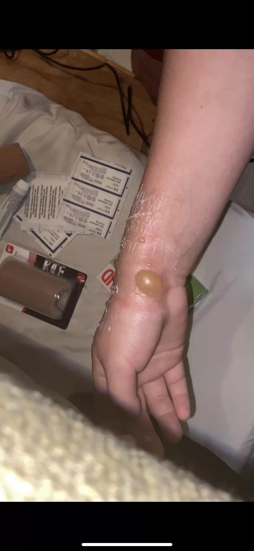 2nd degree temptation to pop