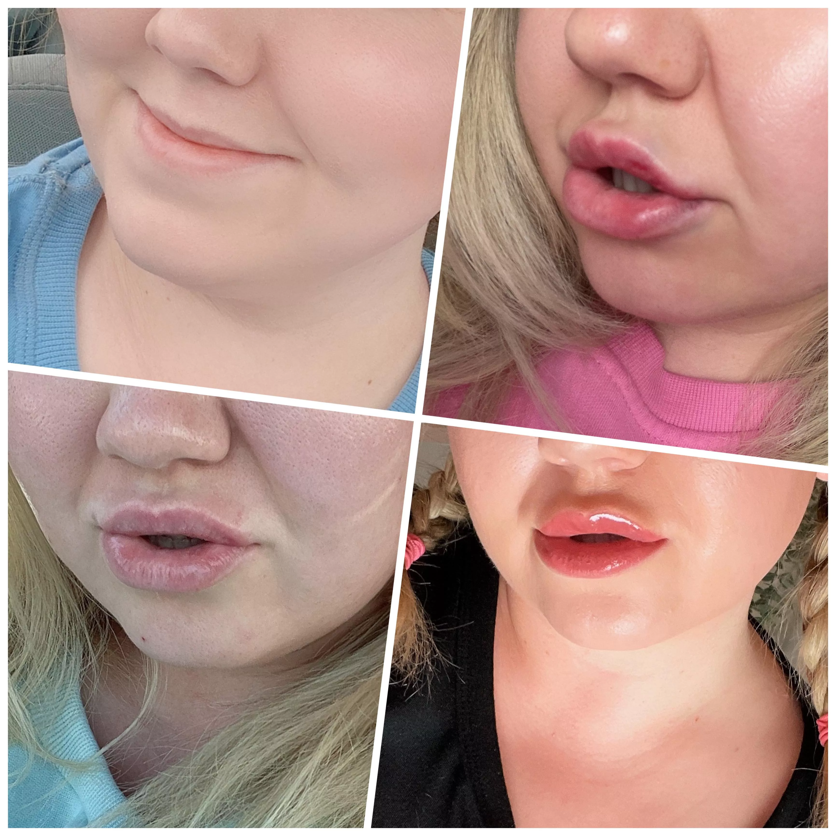 Then & now. I’ve had 3ml in total & im going for one more tomorrow. What’s next? 🙊