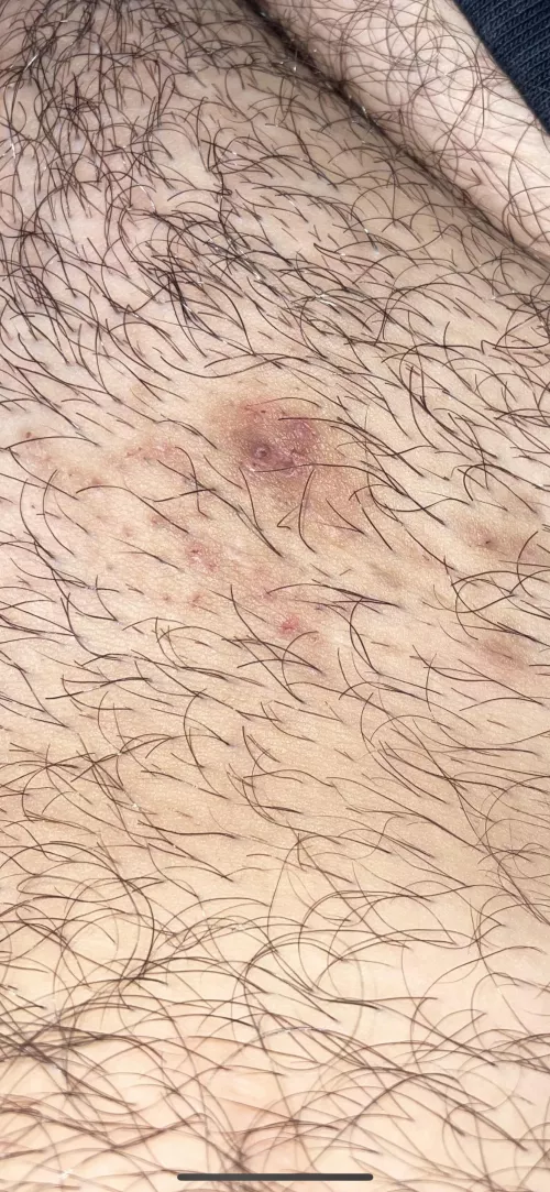 Ingrown hair in the pubic area that’s been there for a year now. Popped it before, tried picking at it multiple times. When I try to squeeze it now, nothing happens. Any ideas or recommendations?