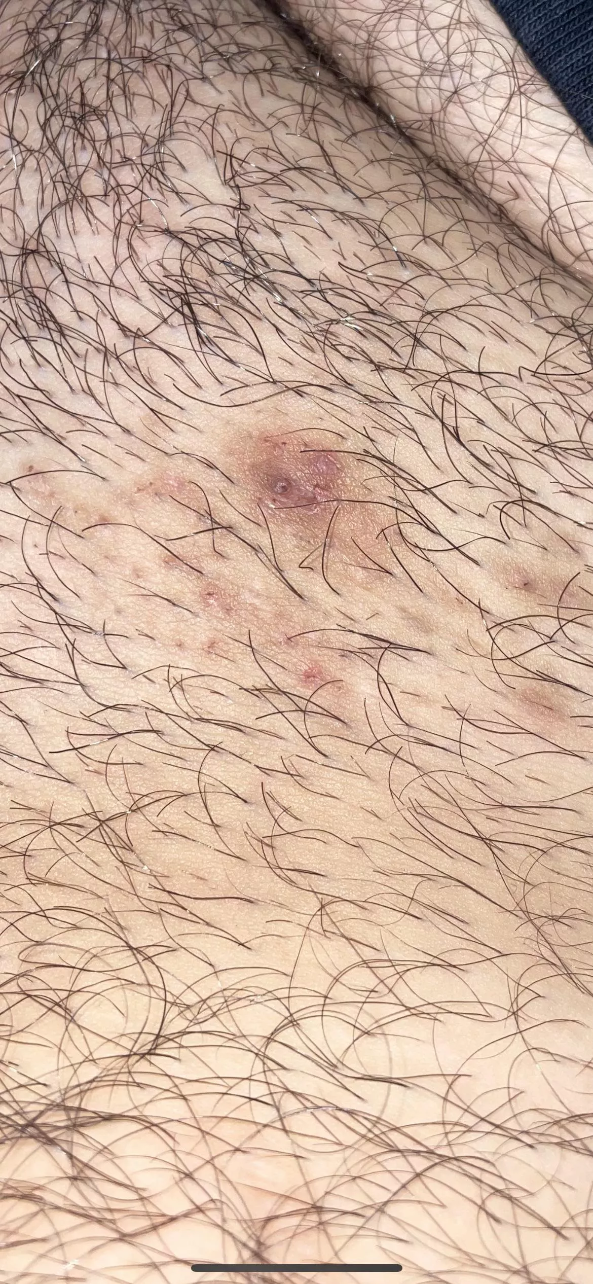 Ingrown hair in the pubic area that’s been there for a year now. Popped it before, tried picking at it multiple times. When I try to squeeze it now, nothing happens. Any ideas or recommendations?