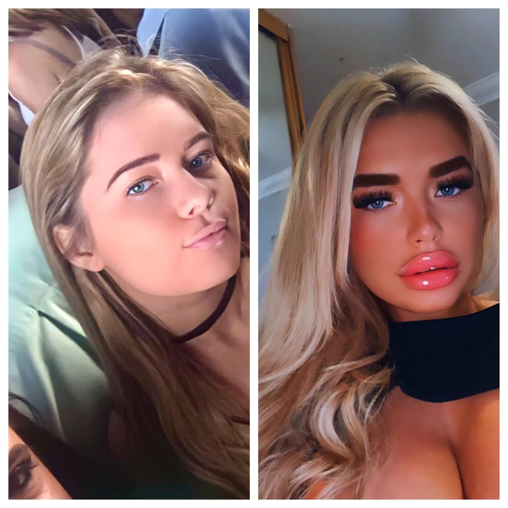 Another lip filler. Cute face girl to Barbie doll face complete