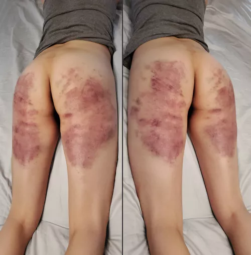 [f] My lovely marked ass 24 hours after an intense beating.