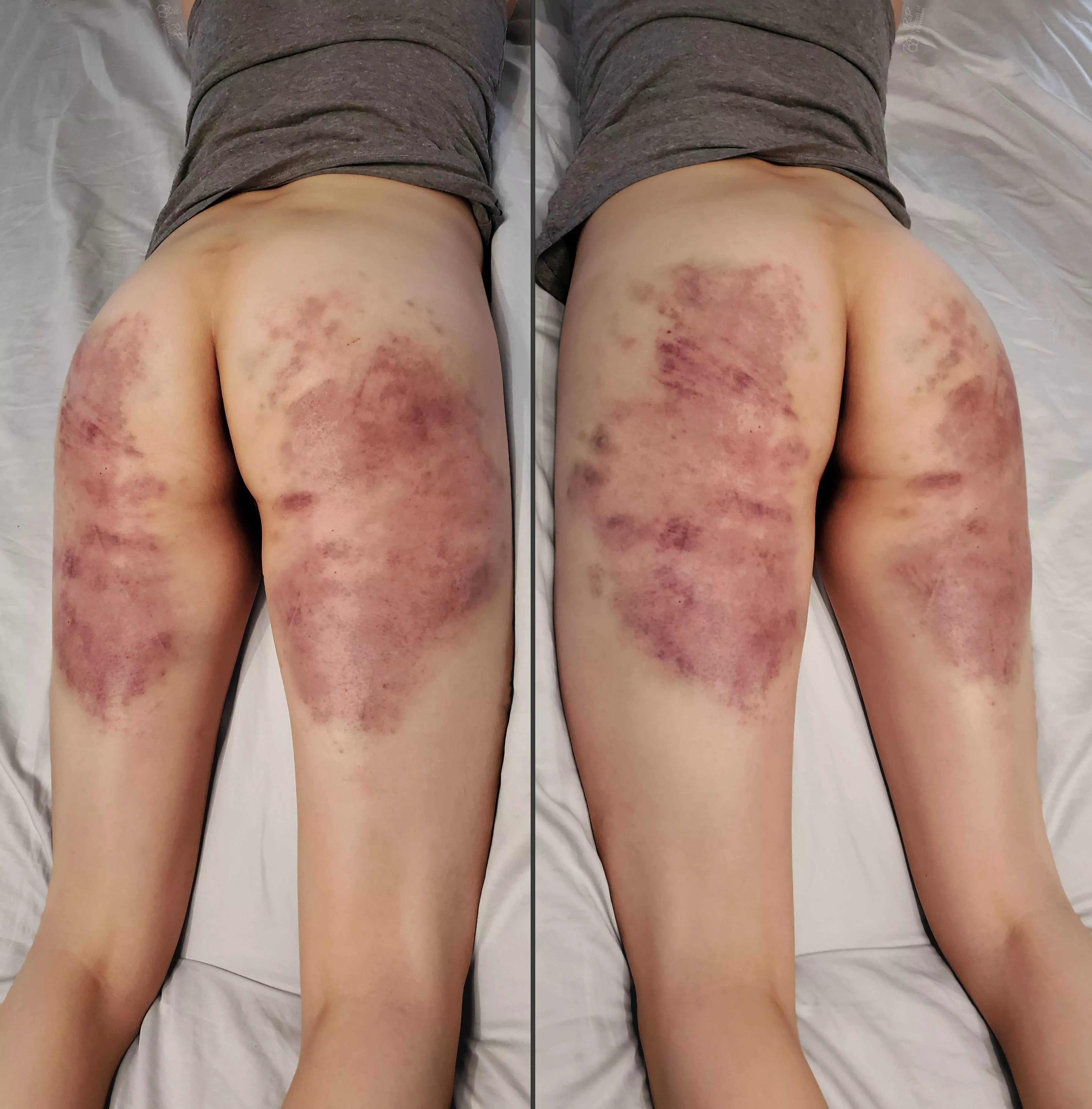 [f] My lovely marked ass 24 hours after an intense beating.