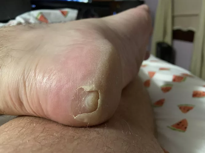 Forbidden pop: blister-within-a-blister