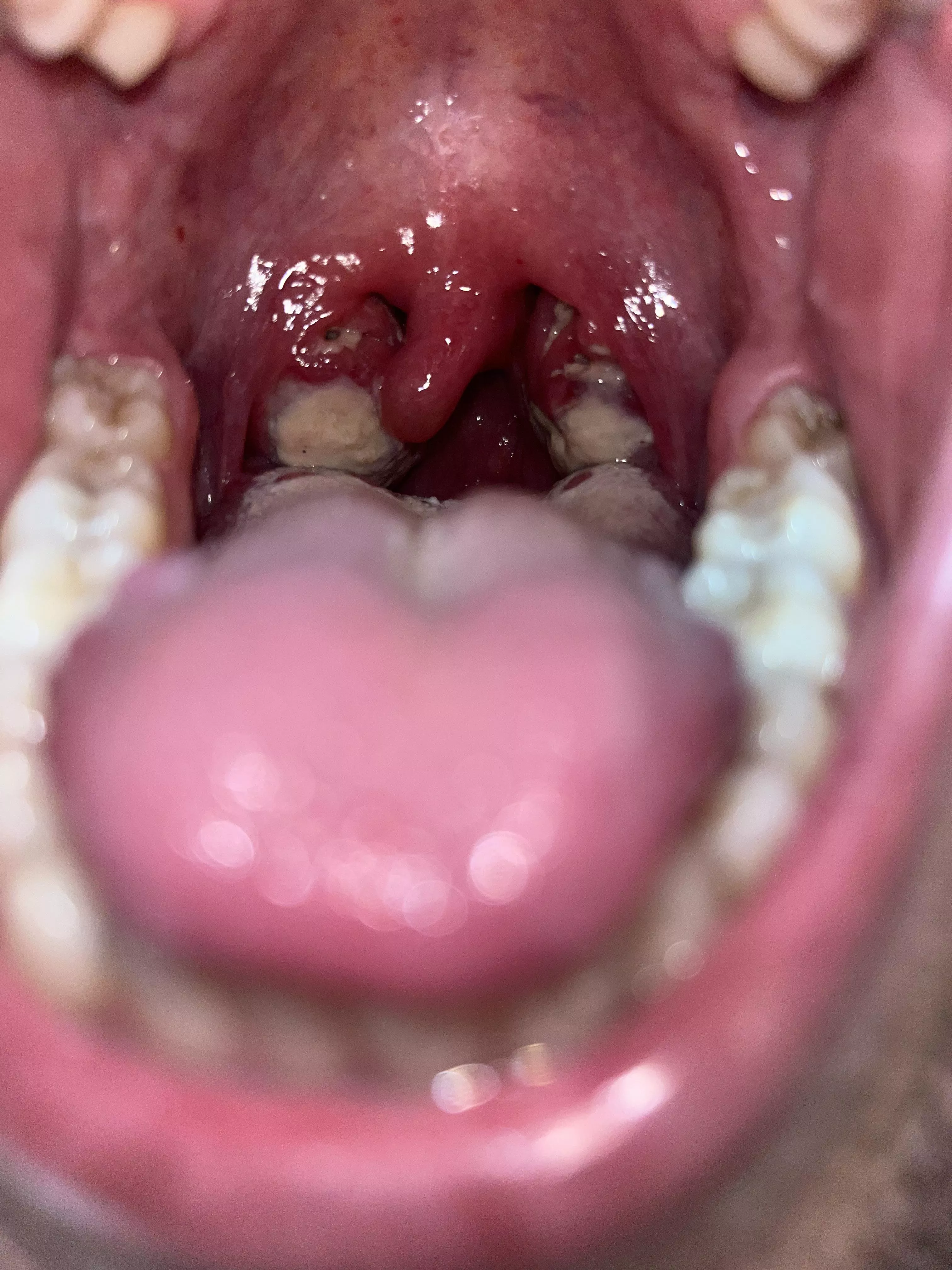 Infected with Mono and tonsillitis 😍 worst pain