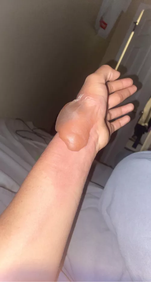 Geez this thing is so big probably one of the biggest blisters I’ve seen