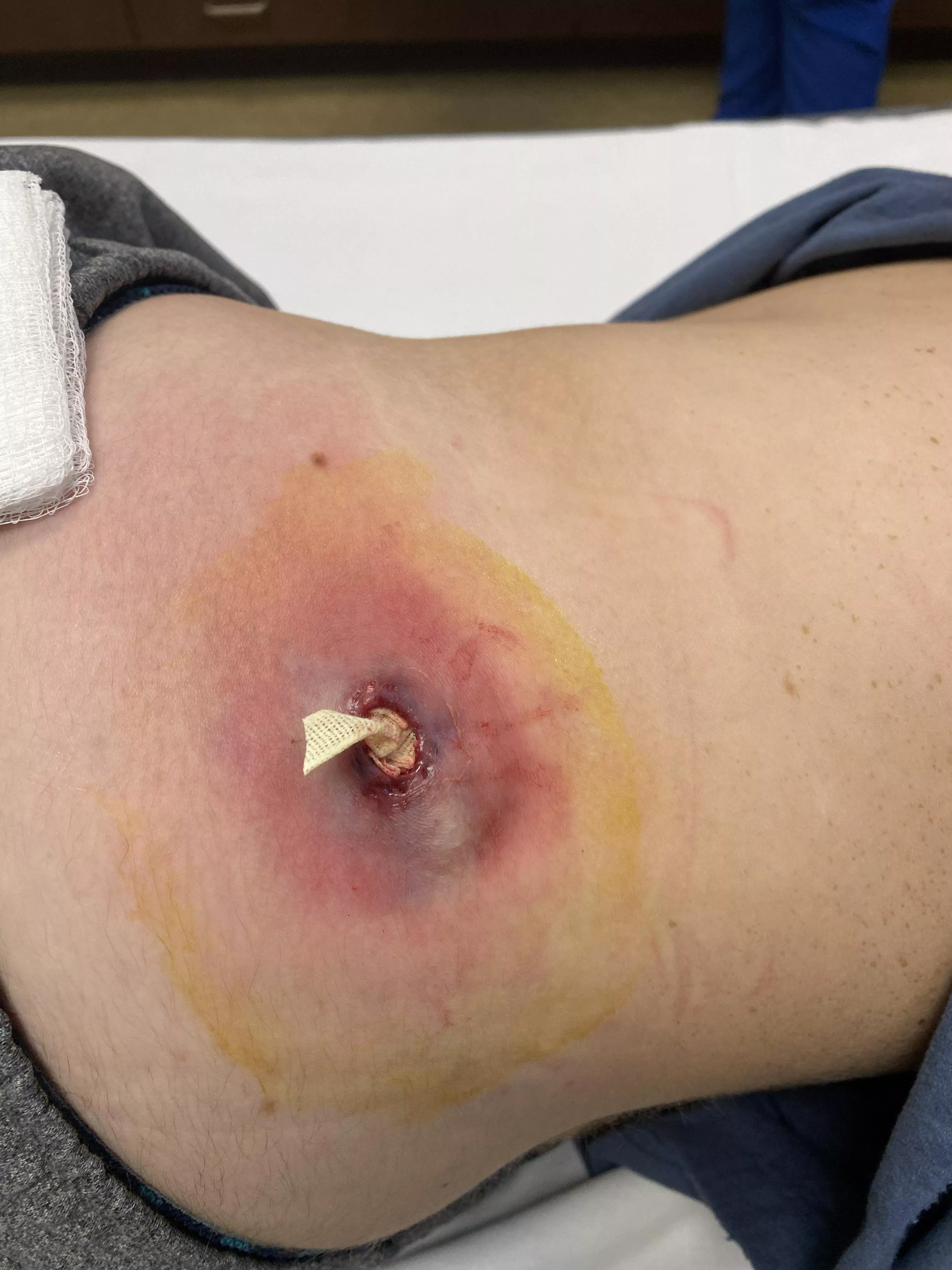 Sebaceous Cyst drained and packed. Ask away with questions!