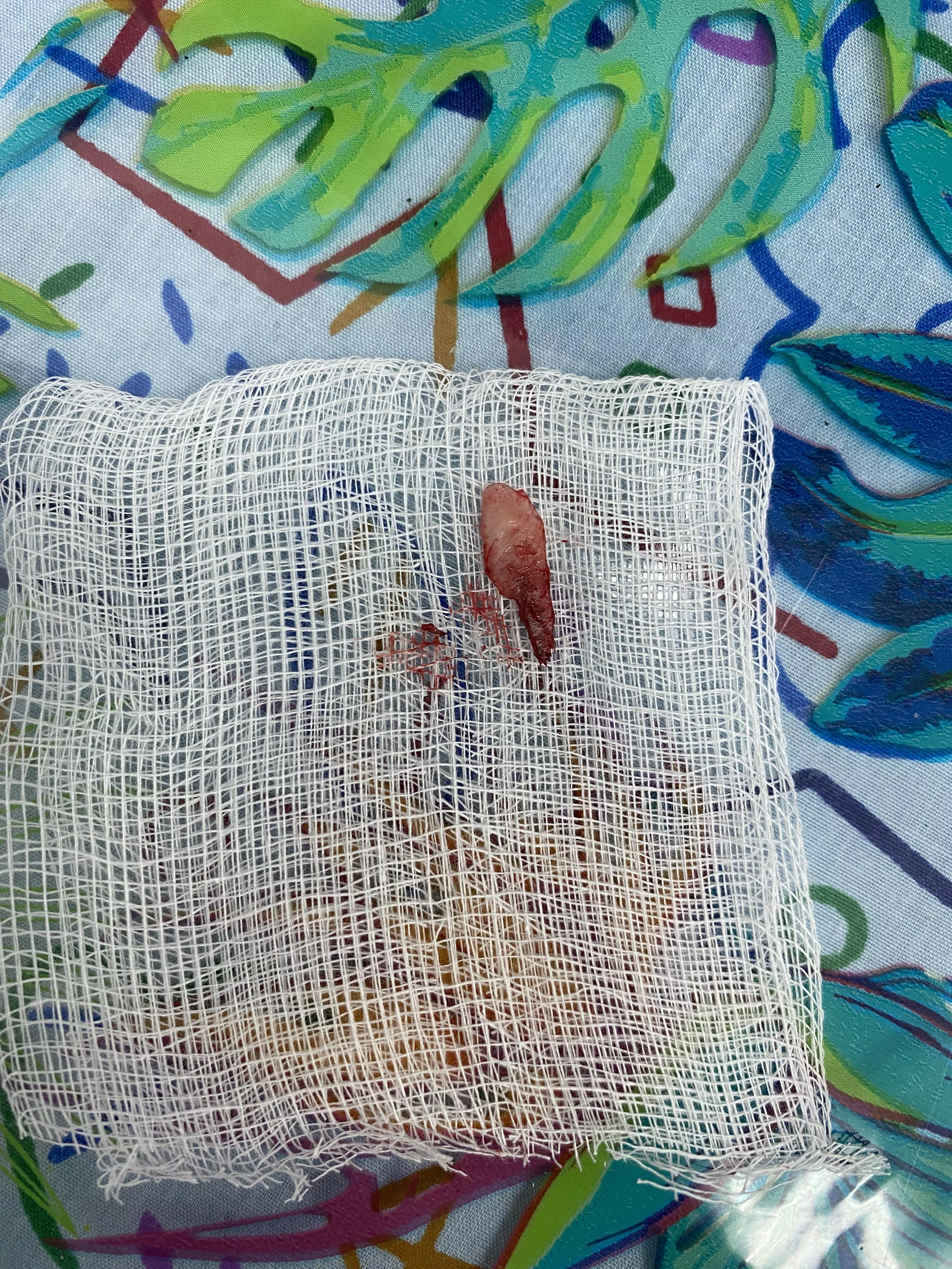 [UPDATE] For the two ingrown toenail posts I made (semi ama)