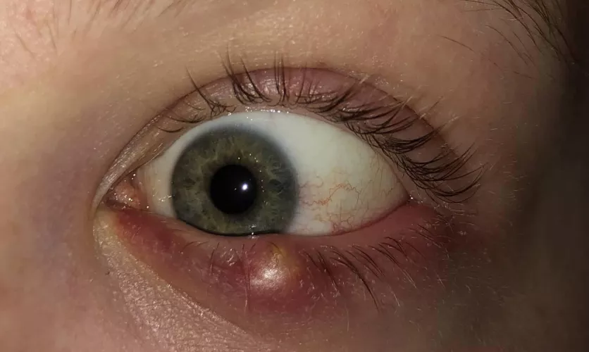 Found a pic of this truly gnarly stye that I had last year. It tortured me for about a week until finally draining on its own