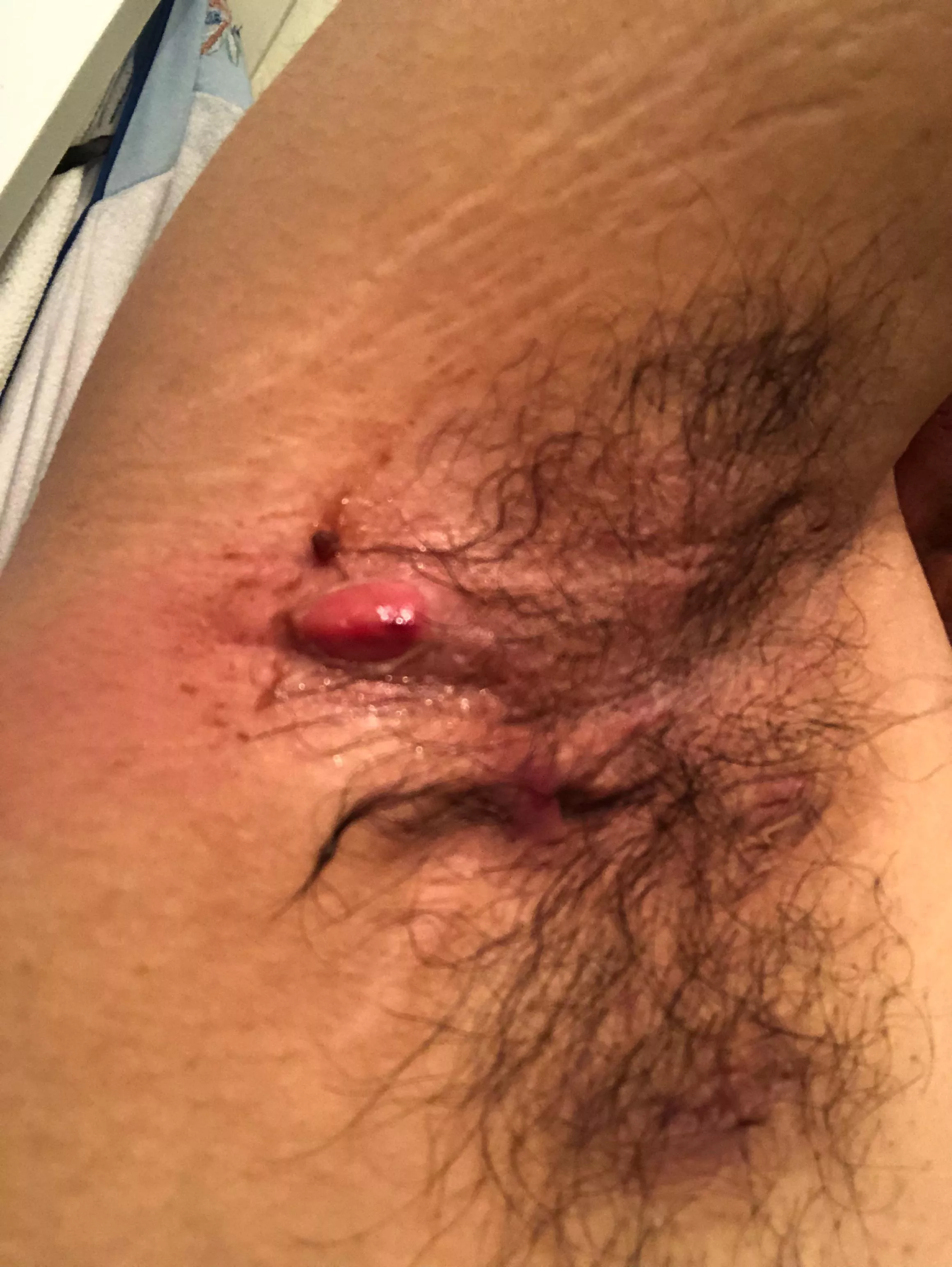 Painful armpit boil begging to be popped