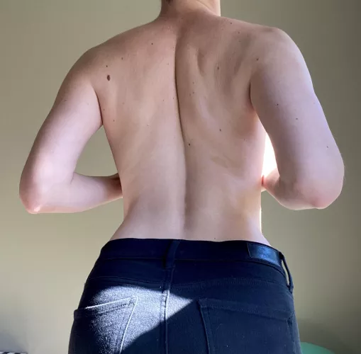 Shoulder freckles [F26]