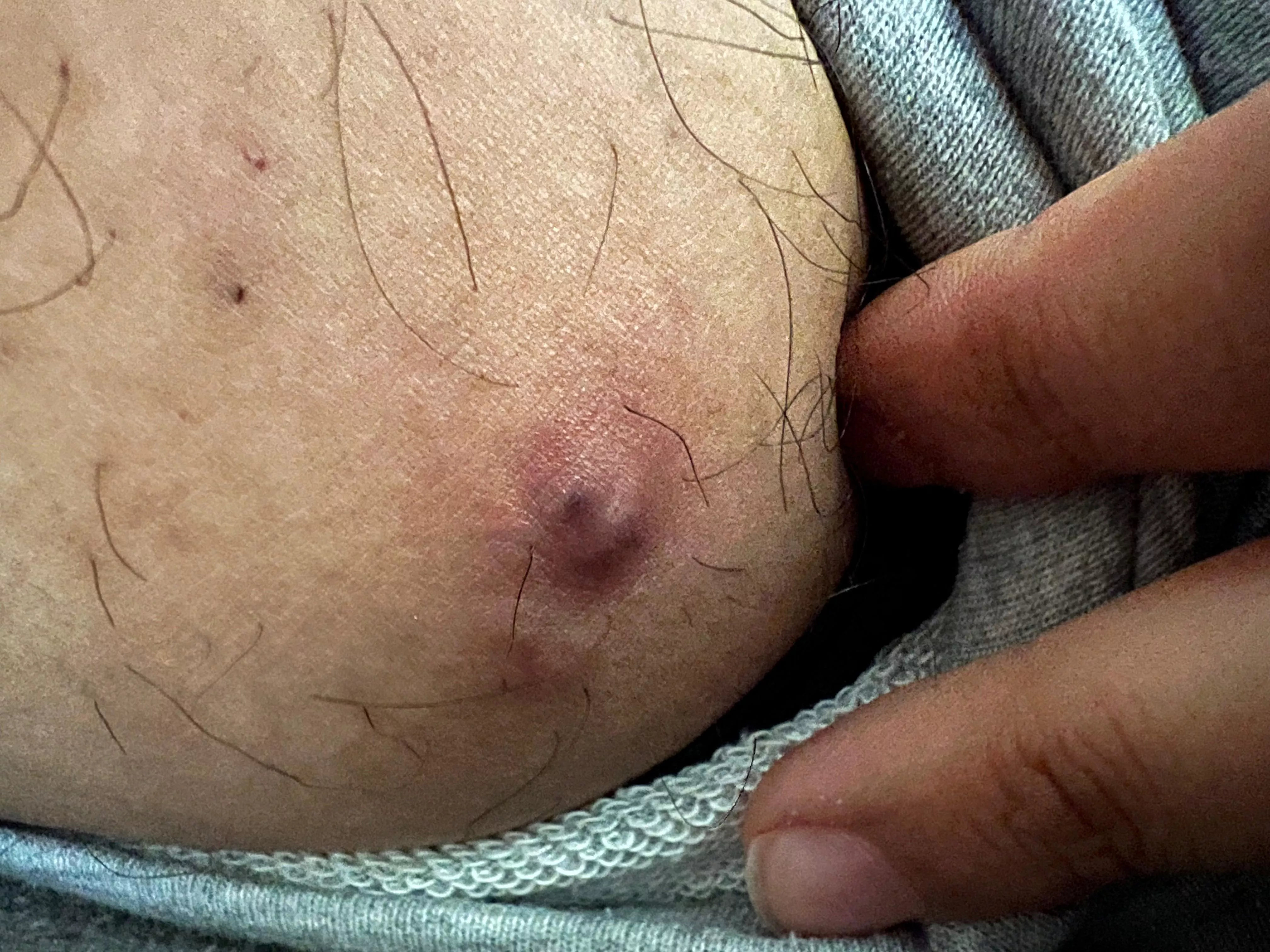 Ingrown hair? Boil? Hurts like a mfer!