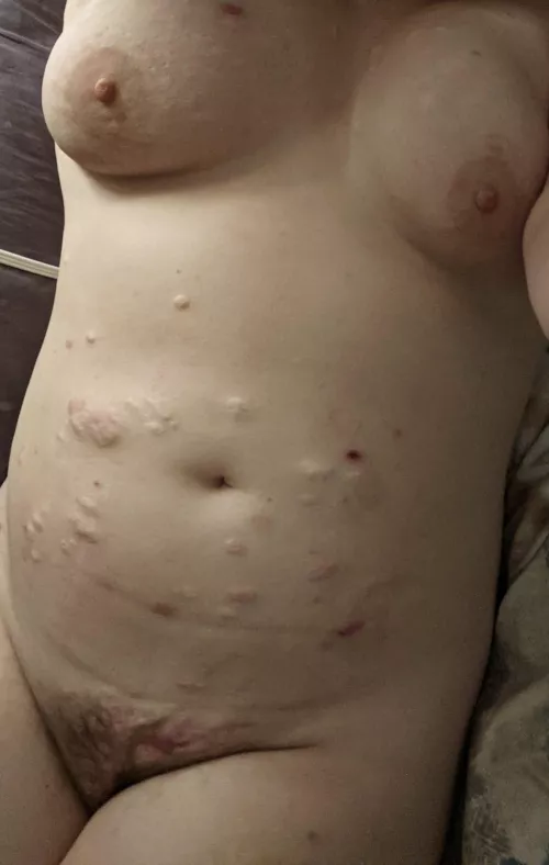 29F, 5'7, 190 lbs. Trying to gain confidence again despite the scars.