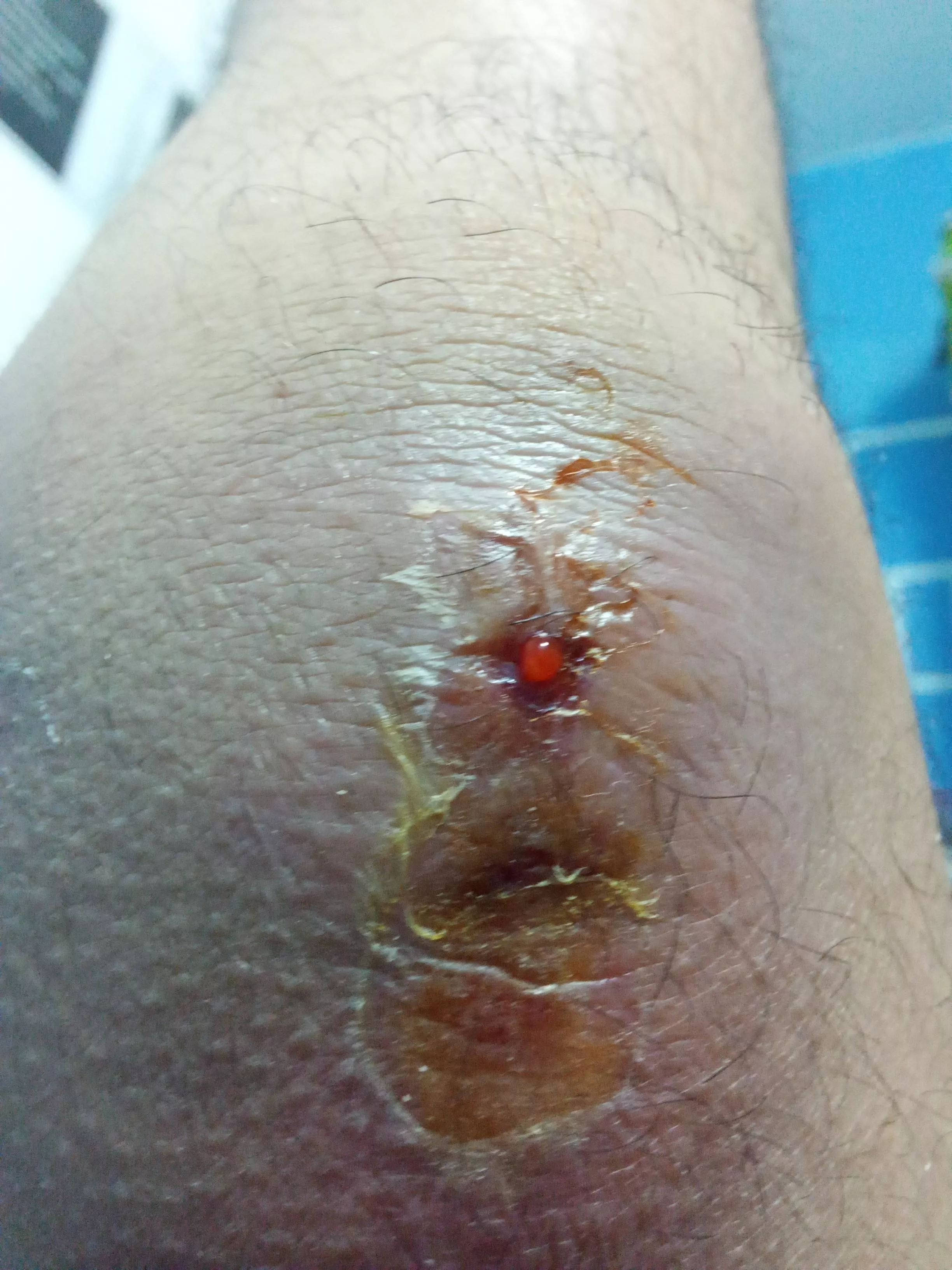 [GROSS] Went to a clinic to get this thing on my knee popped. After the procedure, doctors wrapped it in a bandage and gave me some antibiotics to eat. That was 2 days ago. Here it is now.