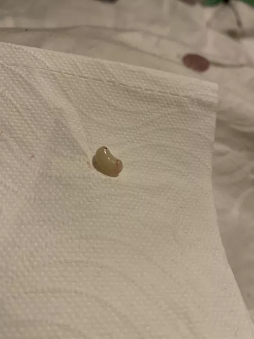I had a cyst on my labia majora that came to a head. Couldn’t record the actual pop as I didn’t have a free hand but this is what popped out when I squeezed! I think I got the sac!