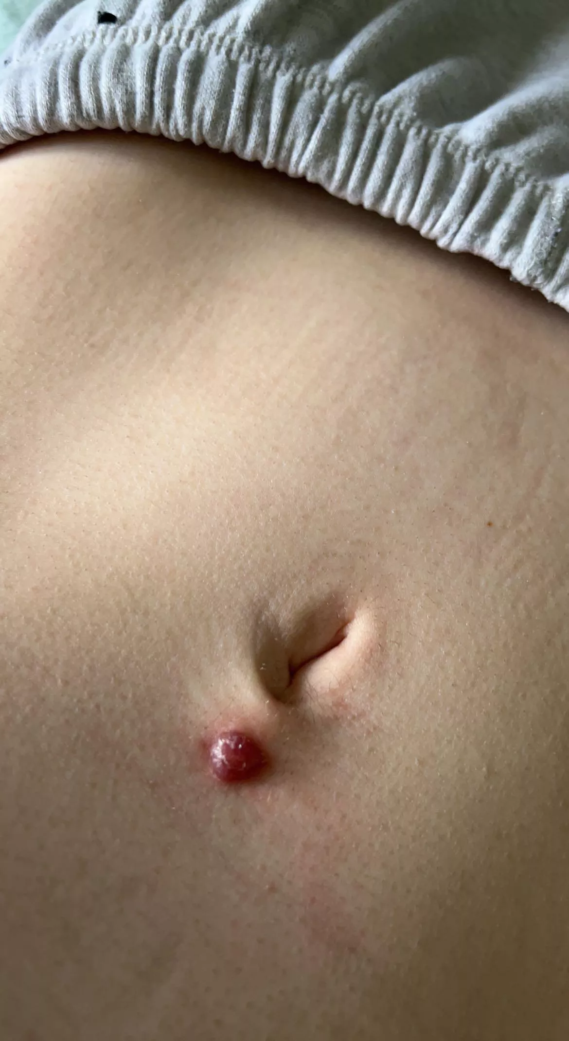 Just took out belly button piercing after 2 years with this bump, stuff comes out of it what should I do to help it now?