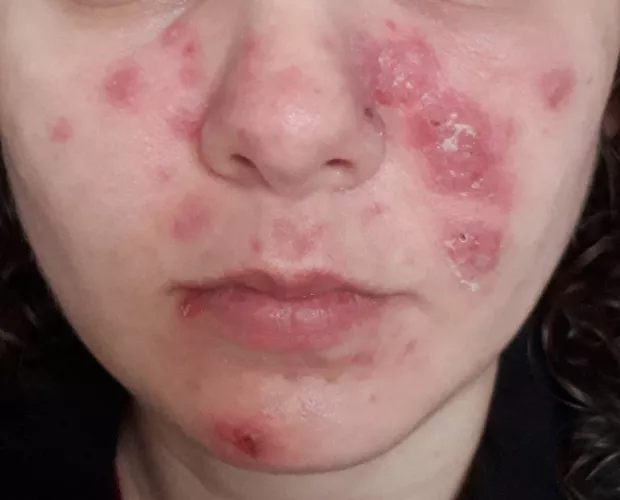 Kind of wish I knew about this sub when I had cystic acne. I had so many good pops that went unfilmed. Thank god for Accutane.